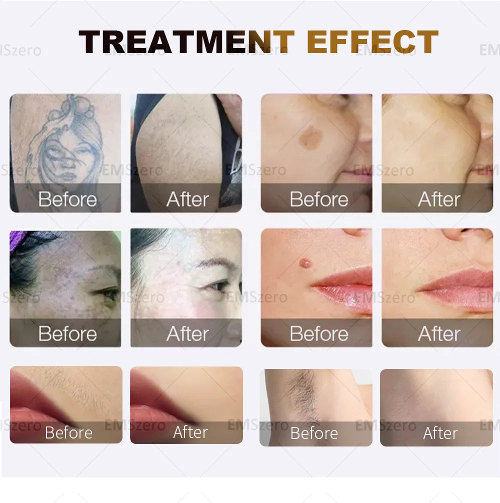 3000W Diode Laser Freezing Point Painless Hair Removal Picosecond Laser 532/1220/1064/755 Tattoo Removal Two In One Machine.