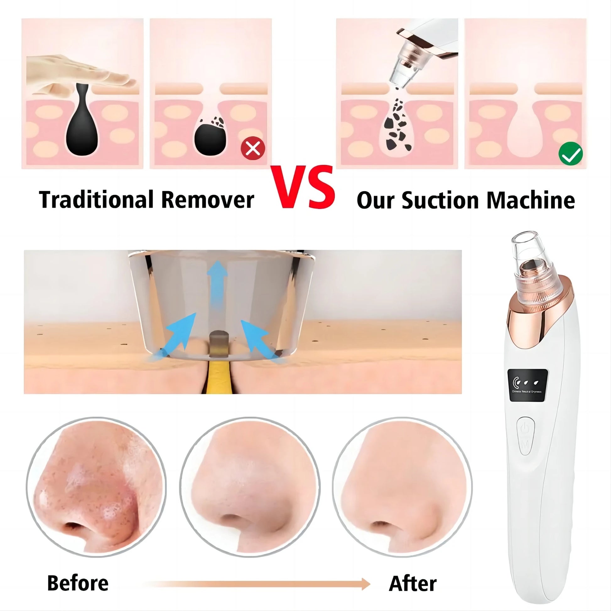 Newest Technology Blackhead Remover Vacuum Pore Cleaner for Face&Nose Blackhead Removal Kit Electric Acne Facial Extractor Tool.