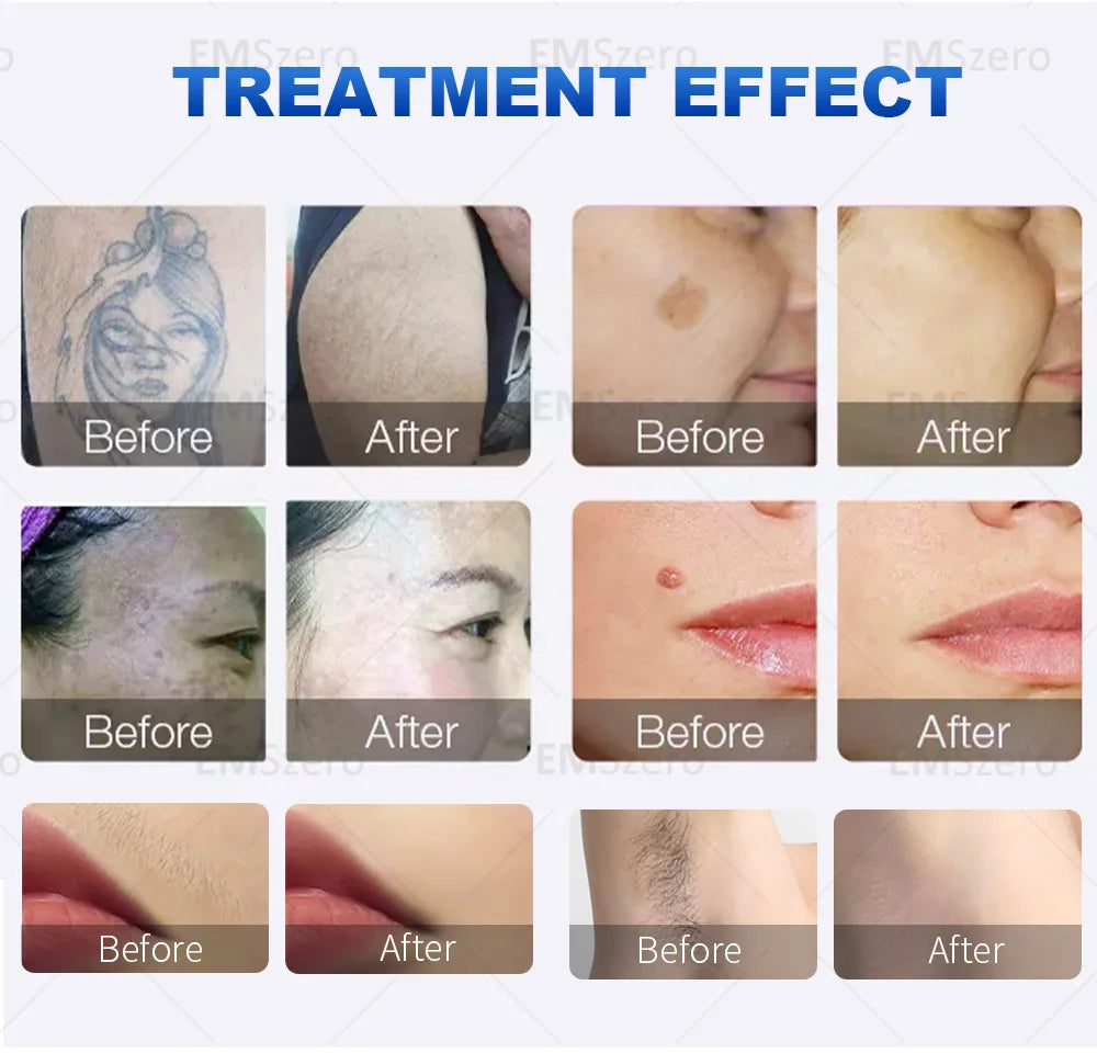 3000W Diode Laser Freezing Point Painless Hair Removal Picosecond Laser 532/1220/1064/755 Tattoo Removal Two In One Machine.